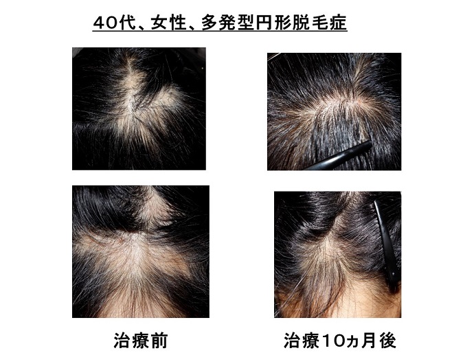 円形脱毛症　病院